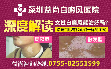 深圳白癜风医院女性白癜风患者应该如何进行护理工作