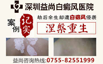 深圳白癜风医院讲解白斑的常见病因是什么